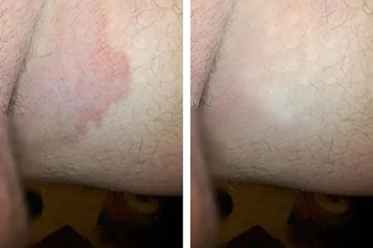 Comparación de una zona irritada antes y después